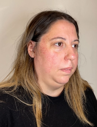 SKINCARECONSULTBEFORE2 2