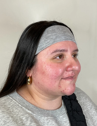 SKINCARECONSULTBEFORE3 2