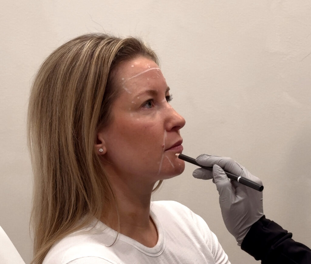 botox