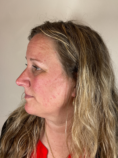SKINCARECONSULTBEFORE1