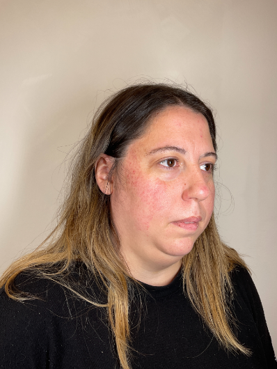 SKINCARECONSULTBEFORE2