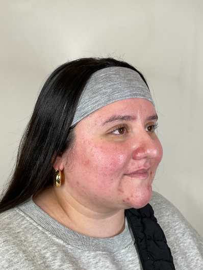 SKINCARECONSULTBEFORE3